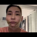 ヒカルが整形手術を報告！術後の腫れた“パンパン顔”に視聴者から痛々しいとの声続出